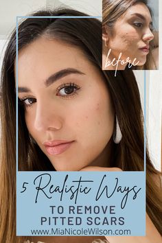 How to get rid of acne scars before and after Pitted Acne Scar Removal, Homemade Essentials, Honey Baking, Mikey Kun, Scar Remedies, Mask For Acne, Microneedle Derma Roller, Facial Scars, Furniture Cleaning