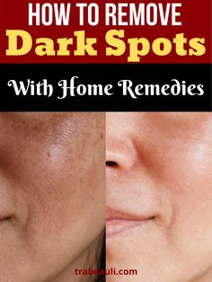 Looking for what causes and best treatment dark spots on face at home? Check out how to get rid of dark spots on face overnight remedies. Skin Care For Dark Spots, Skincare For Wrinkles, Dark Spots Remedies, Wrinkles Remedies, Dark Spot Remover, Skin Care Specialist, Oily Skincare, Dark Spots On Face