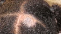 Scalp Conditions: Pictures, Causes, and Treatments Dandruff Causes, Scalp Problems, Hairstyle Tips, Bald Spot, Pelo Afro, Lost Hair, Hair Food, Dry Scalp