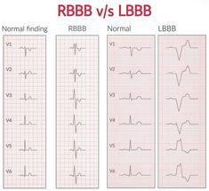 Left Bundle Branch Block, Blood Gas Interpretation, Anesthesia School, Nursing School Studying Cheat Sheets, Bundle Branch Block