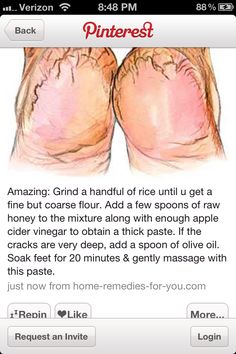 Haven't tried this personally, but it just may be one fantastic  idea! Feet remedy for dry cracked heels Dry Cracked Heels, Home Health Remedies, Cracked Heels, Beauty Remedies, Skin Care Remedies, Body Skin Care Routine, Diy Skin Care, My Chemical, Beauty Skin Care Routine