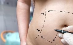 Top 8 Tummy Tuck Recovery Tips from Plastic Surgeons Surgical Procedures, Plastic Surgery Procedures, Excess Skin, Mommy Makeover, Reconstructive Surgery, Cosmetic Procedures, Tummy Tucks, Loose Skin