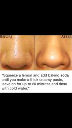 Skin Tips Jus Lemon, Blackhead Remedies, Black Heads, Get Rid Of Blackheads, Beauty Remedies, Acne Remedies, Skin Pores, Homemade Beauty Products, Health And Beauty Tips