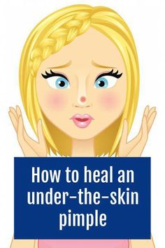 Struggling with a blind pimple under skin? Discover foolproof methods for how to get rid of a pimple that's under the skin quickly, sans side effects like scarring. Underground Pimple, Hard Pimple, Pimple Remedies, Deep Pimple, Zit Remedy, Huge Pimple, Inflamed Pimple, Painful Pimple, Redness Pimple