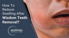 How Long Does It Take Swelling After Wisdom Teeth Removal To Go Down. There are any references about How Long Does It Take Swelling After Wisdom Teeth Removal To Go Down in here. you can look below. I hope this article about How Long Does It Take Swelling After Wisdom Teeth Removal To Go Down can be useful for you. Please remember that this article is for reference purposes only. #how #long #does #it #take #swelling #after #wisdom #teeth #removal #to #go #down Wisdom Teeth Swelling, After Wisdom Teeth Removal, Wisdom Tooth, Wisdom Teeth Removal, Tooth Removal, Reduce Swelling, Magic Tattoo, Diy Chicken, Tooth Extraction