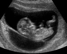 12 Week Ultrasound Pictures, 12 Week Ultrasound, 16 Weeks Pregnant Ultrasound, Endoscopy Procedure, Trimester By Weeks, Tips For Pregnant Women, Pregnancy Calculator