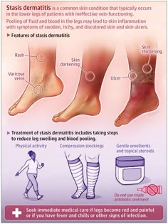 an info poster describing how to treat foot pain