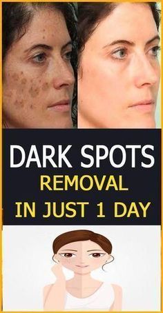 Sun Spots Removal, Dark Spots Removal, Open Pores, Remove Dark Circles