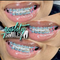 Star Shaped Braces, Cotton Candy Braces, Braces Color Patterns, Braces Colors With Rubber Bands, 2 Braces Colors Ideas, Power Chain Braces Black Women, Braces With Power Chains, Braces For Overbite