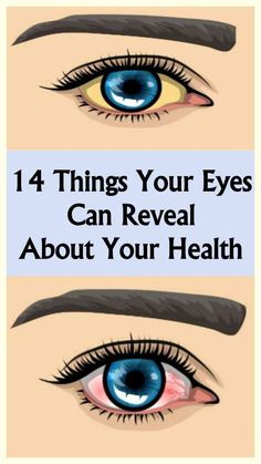 14 Things Your Eyes are Trying to Tell You About Your Health Protruding Eyes, Computer Vision Syndrome, Shimmer Lights, Eyes Problems, Computer Vision, Eye Strain, Eye Health