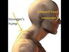 Dowager's Hump, Neck Exercises, Posture Exercises, Simple Exercises, The Bump, Back Exercises, Neck Pain, Head And Neck, Massage Therapy