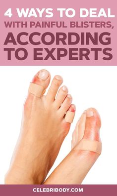 Blisters on the bottom of feet and heels can sideline you for days – or even weeks. We asked experts to weigh in on the best blister treatments and how to get rid of blisters once they form. How To Treat Blisters, Get Rid Of Warts, Cracked Heels, Fruit Water, Celebrity Workout, Fitness Advice, Healthy Ideas, Healthy Lifestyle Tips, Total Body Workout