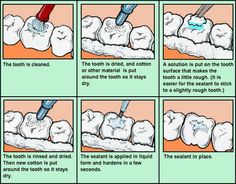 Tooth repair is essential to avoid tooth pain.  My post explains... Tooth Anatomy, Teeth Anatomy, Teeth Whitening Dentist, Tooth Ache Relief, Remedies For Tooth Ache, Tooth Repair, Chronic Pain Relief, Teeth Bleaching