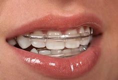 When Should You Get Retainers?