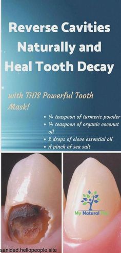 #Dental #for #HealthyLiving #Secrets #Radiant #Unlocking #Smile #Care #Tips #HealthTips #FitLife #NutritionTips #a #HealthyLifestyle #FitnessTips Reverse Cavities Naturally, Cavity Remedy, Baking Soda Teeth, Reverse Cavities, Tooth Ache Relief, Tooth Cavity, Tooth Decay Remedies, Homemade Toothpaste