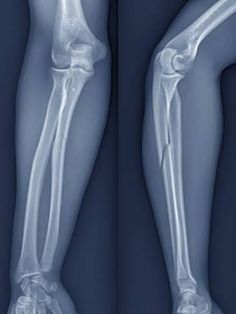 an x - ray view of the lower leg and upper leg, with bones exposed