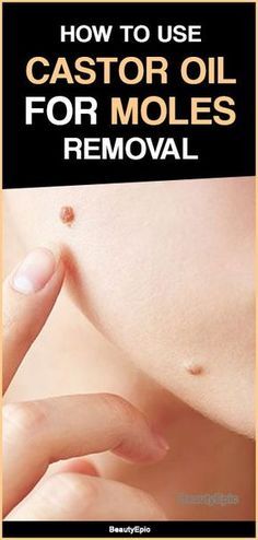 Cancerous Moles, Red Moles, Skin Moles, Mole Removal, Oil Benefits, Oil Uses, Natural Health Remedies