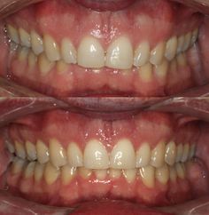 Deep bite treated with Invisalign. Actual patients of Impressions Orthodontics. Indian Fashion Dresses, Oral Health, Indian Fashion, Fashion Dresses, Dresses