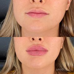 Allergan Botox, Dermal Fillers Lips, Fuller Lips Naturally, Aesthetic Medical, Lips Inspiration, Face Fillers, Botox Lips, Face Treatments, Facial Fillers