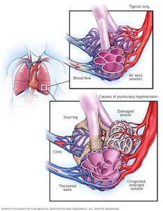 an image of the heart and blood vessels in two different areas, one is red