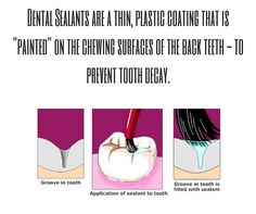 Sealants are an excellent way to protect back teeth against dental decay and cavities. Both children and adults can benefit from dental sealants. Stages Of Tooth Decay, Dental Composite Restoration, Reverse Tooth Decay Heal Cavities, Tooth Filling, Dental Decay, Dental Health Activities, Dental Assistant Memes Hilarious, Health Activities