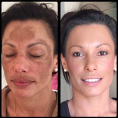 Hydrafacial Before And After, Plasma Facial, Dark Spot Remover For Face, Lemon On Face, Sandalwood Powder, Water Lemon, Mantra For Good Health, Dark Spots On Skin