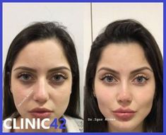 Nose Surgery Aesthetic, Double Jaw Surgery, Jaw Reduction Surgery, Face Fillers, Facial Surgery