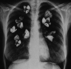 an x - ray shows the chest and lungs