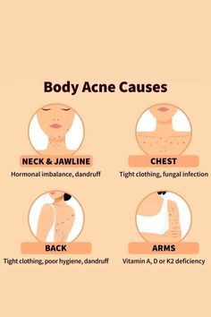 Bad Acne, Skin Advice, Acne Skincare, Natural Face Skin Care, Natural Acne Remedies, Types Of Acne, Acne Causes, Body Acne