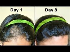 (8) She turned her Thin hair to Thick hair in 1 week - Fenugreek Seeds oil for Hair Growth, Long hair - YouTube Hair Growth Long, Fenugreek For Hair, Thicker Hair Naturally, Hair Fall Solution, Thick Hair Remedies, Thick Hair Growth, Get Thicker Hair, Hair Care Remedies, Oil For Hair Growth