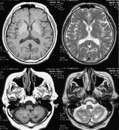 an mri scan shows the different areas of the brain