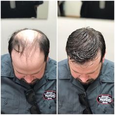 Hair Regrowth Before And After, Hair Transplant Before And After, Hair Regrowth For Men, Mens Hair Regrowth, Strong Healthy Hair, For Healthy Hair Growth, Hair Plugs, Dramatic Hair, For Healthy Hair