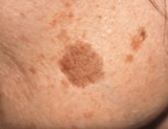 Simple Trick to Remove Brown Spots from Your Skin | TipHero