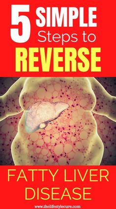 Want to reverse fatty liver disease? Well it's possible! As a medical doctor, chronic diseases make up the majority of cases that doctors see on a regular basis. But what most don't know is that these diseases are lifestyle related, meaning you can change the outcome! Read to know the 6 proven lifestyle changes that will reverse fatty liver disease and other chronic diseases. #reversefattyliverdisease #fattyliverdisease #fattyliver #howtogetridoffattyliver #fattyliverdiet Liver Cleansing Foods, Cleansing Foods, Liver Detox Diet, Heal Liver, Liver Cleansing