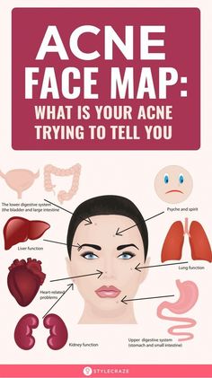 Acne face map is an ancient concept practiced widely in Chinese and Ayurvedic medicines. Want to know more? Check out this post to read about the acne face map. Acne Map, Blind Pimple, Pimples Under The Skin, Bad Acne, Prevent Pimples