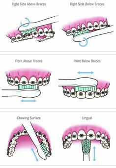 Dental Braces Colors, Braces Food, Cute Braces Colors, Braces Tips, Getting Braces, Cute Braces, Kedokteran Gigi, Brace Face, Braces Colors