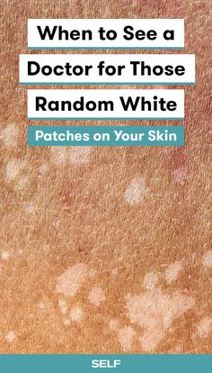 White Skin Patches, Pigmentation Remedy, Dark Patches On Skin, How To Become Healthy, Become Healthy, Dry Skin Patches, Spots On Face