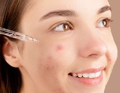 How to Deal with a Big Pimple on Your Face: Expert Tips for Quick Relief - Real Beauty School Healthy Skin