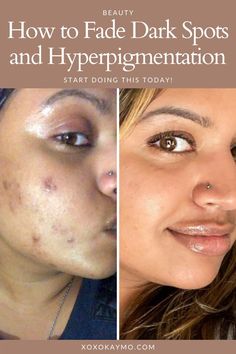 Skin Blemishes How To Get Rid, How To Get Rid Of Acne And Dark Spots, How To Remove Blemishes From Face, Best Skin Care Products For Acne Dark Spots, Pimple Scar Removal Dark Spots, Dark Acne Spots Remedies, How To Remove Hyperpigmentation On Face, Blemishes On Face Remedies, Get Rid Of Dark Spots On Face