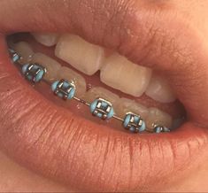 Bottom Teeth Braces, Braces Ideas