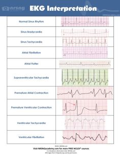 common ecg ekg rhythms Ekg Rhythms, Ekg Tattoo, Ekg Interpretation, Medical Assisting, Ecg Interpretation