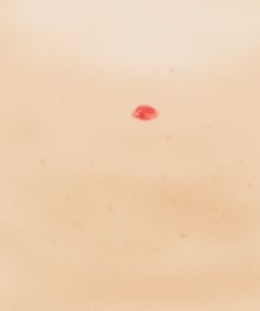 Red Spots On Skin How To Get Rid, How To Remove Red Spots On Face, Red Dots On Legs Skin, Red Marks On Skin, Red Dots On Skin, Red Moles On Skin, Red Bumps On Face, Red Spots On Legs, Red Spots On Skin