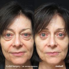 Eye Bag Surgery, Eye Lift Surgery, Baggy Eyes, Under Eye Fillers, Droopy Eyelids, Bulging Eyes, Natural Face Skin Care