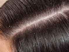 How To Prevent Dandruff, What Is Dandruff, What Causes Dandruff, Dandruff Causes, Dandruff Remedy, Getting Rid Of Dandruff, Dead Hair, Aloe Vera For Hair, Hair Dandruff