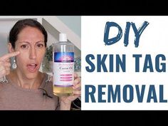 If you are seeking ways to remove skin tags on your body THIS is the video to watch! Learn about the causes of skin tags and how to prevent skin tags natural... Natural Ways To Remove Skin Tags, Getting Rid Of Skin Tags, Castor Oil For Skin Tags, How To Get Rid Of Skin Tags, Skin Tags What Causes, Causes Of Skin Tags, Castor Oil For Skin