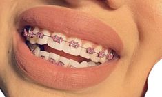 Braces Tips