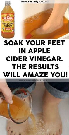 Apple Cider Vinegar Foot Soak, Foot Detox Soak, Apple Cider Vinegar Remedies, Raw Apple Cider Vinegar, Power Bar, Apple Vinegar, Organic Apple Cider, Organic Apple Cider Vinegar, Natural Cold Remedies