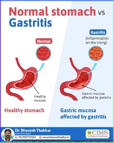 Gastritis is irritation and inflammation of the stomach lining. Here's something you should know about normal stomach vs. #gastritis. . . . #HealthcareTips #health #fitness #healthylifestyle #healthy #fattyliverdiet #Gastro #Gastrodisease #Gastroenterits #GastroDisease #GutHealth #stomachpain #NormalStoamch #Stomachache #gastroenterologist #DrBhaveshThakkar Healthy Stomach, Stomachache, Sleep Remedies, Stomach Ache, Stomach Pain, Free Education, Medical Science, Gym Workout Tips, Creative Ads