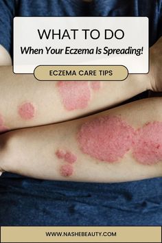 Do These Things When Your Eczema Is Spreading To Curb It Excema Relief, Oily Skin Remedy, Severe Dry Skin, Home Remedy For Cough, Under Eye Wrinkles