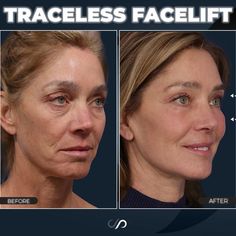 Facelift Recovery, Neck Lift Surgery, Facial Esthetics, Mini Face Lift, Facelift Procedure, Facial Procedure, Chin Implant